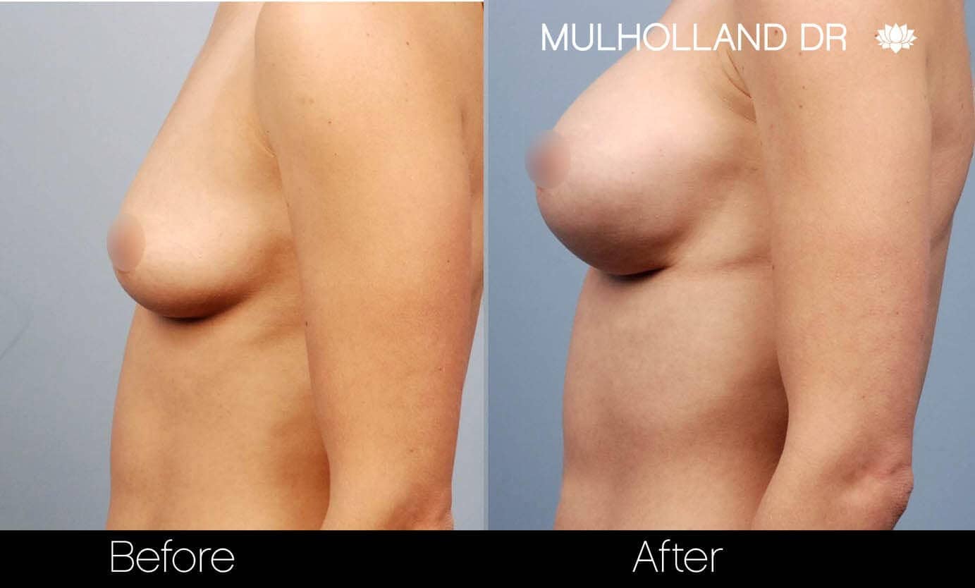 Breast Augmentation - Before and After Gallery - Patient Photo 19