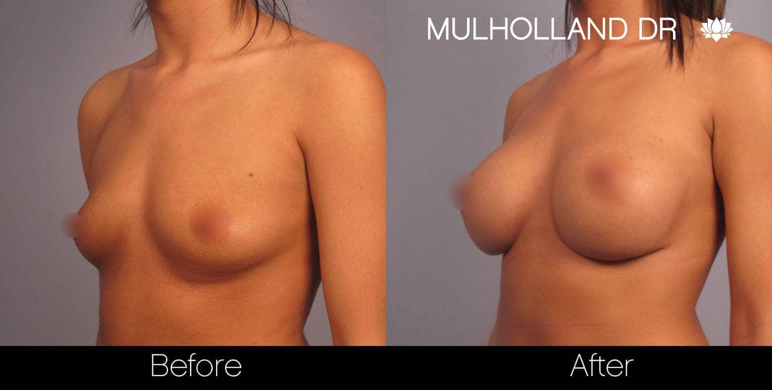 Breast Augmentation - Before and After Gallery - Patient Photo 2