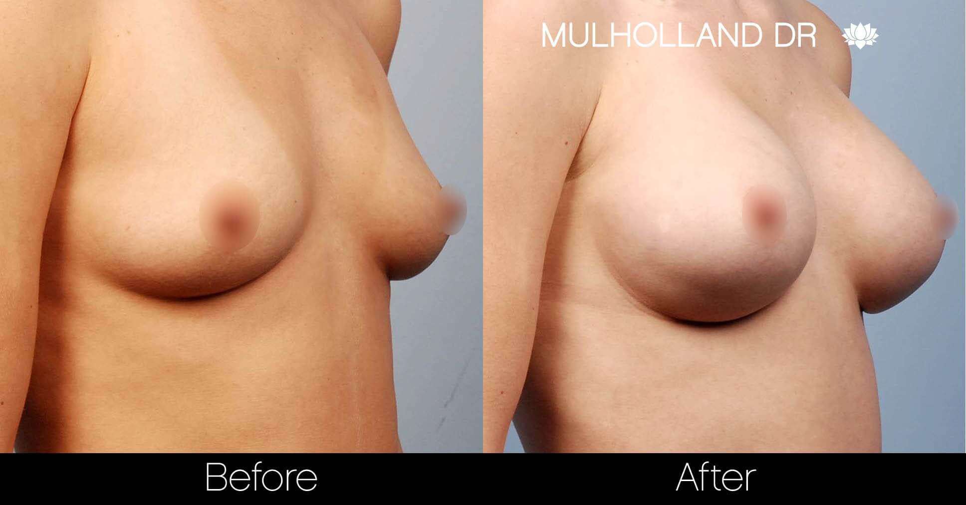 Breast Augmentation - Before and After Gallery - Patient Photo 20