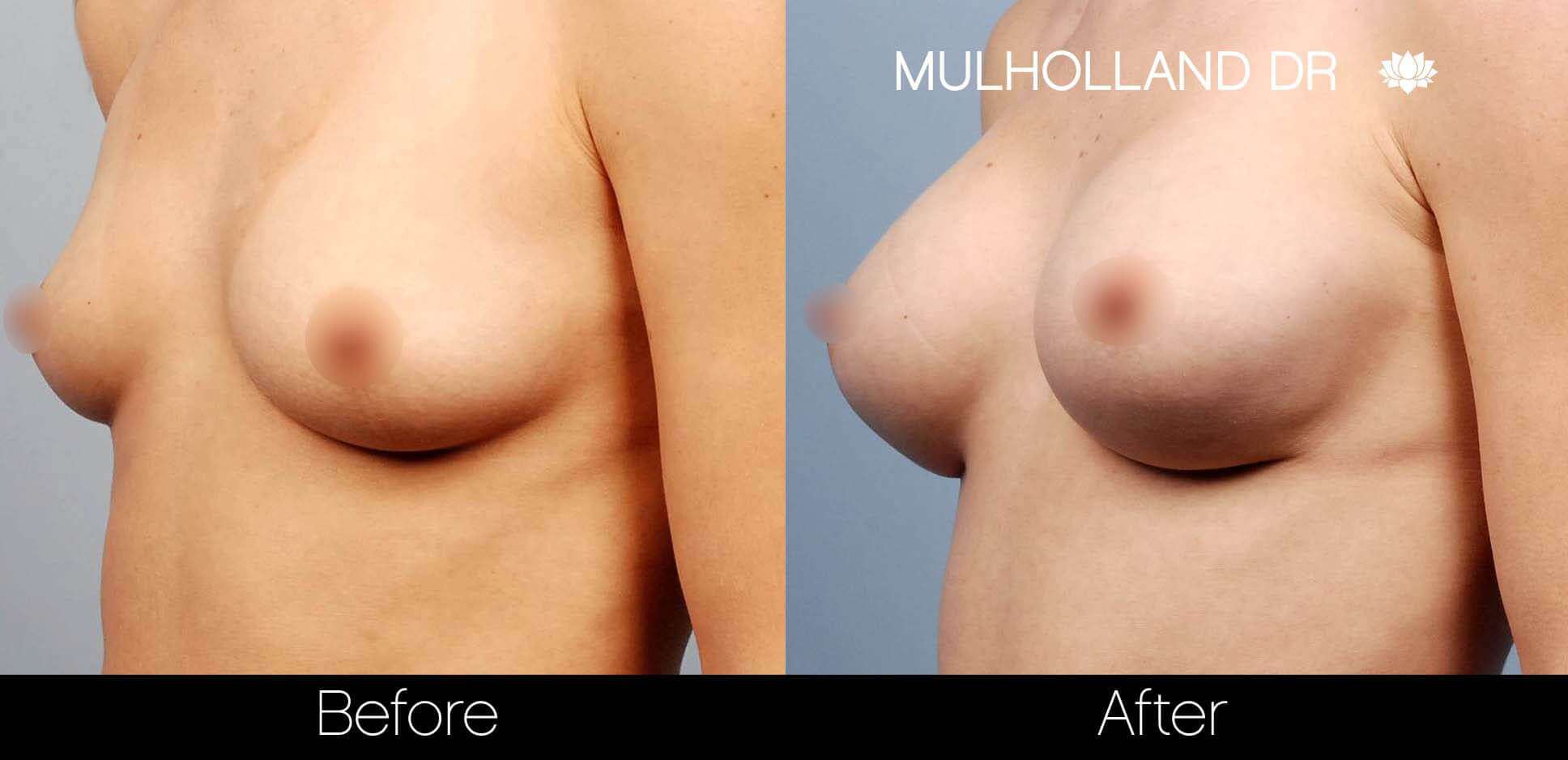 Breast Augmentation - Before and After Gallery - Patient Photo 21