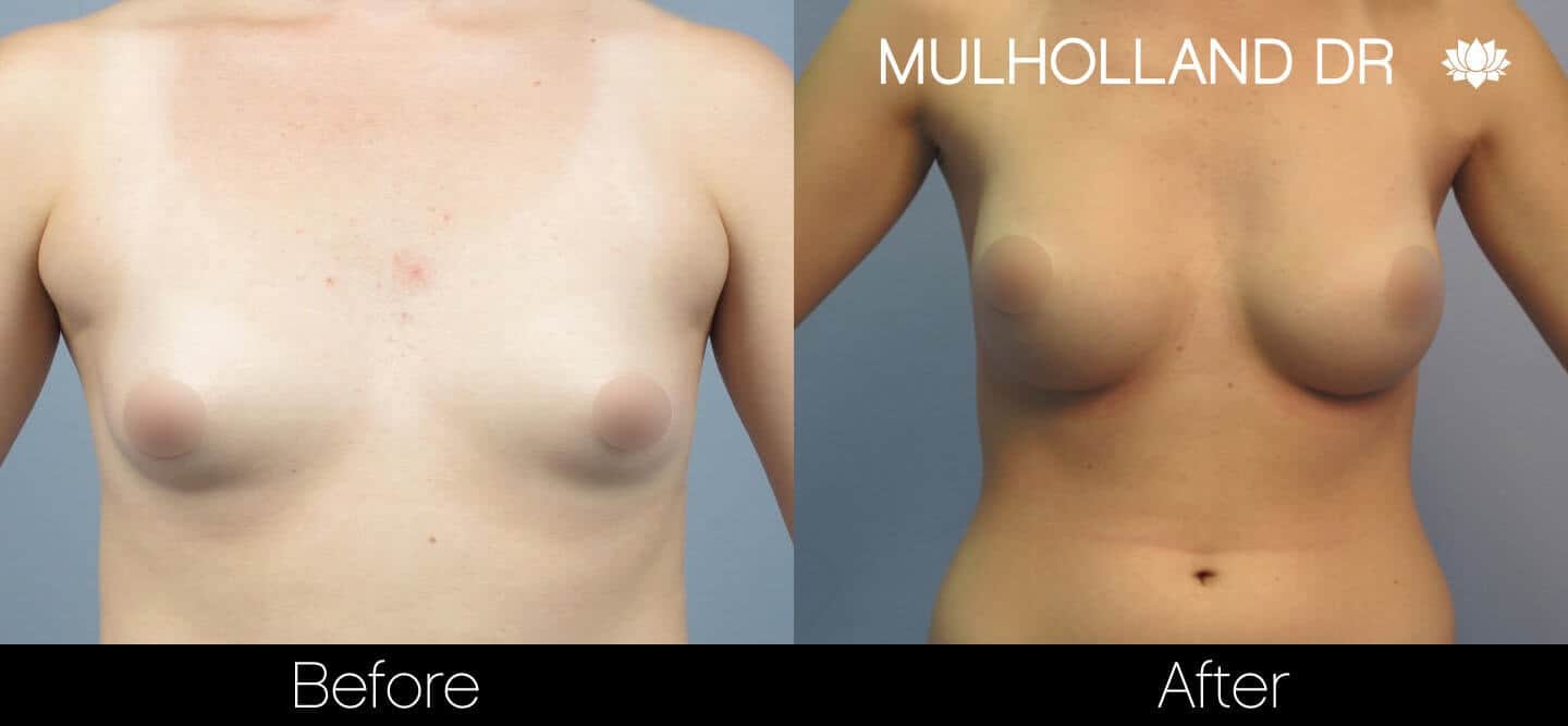 Breast Augmentation - Before and After Gallery - Patient Photo 22