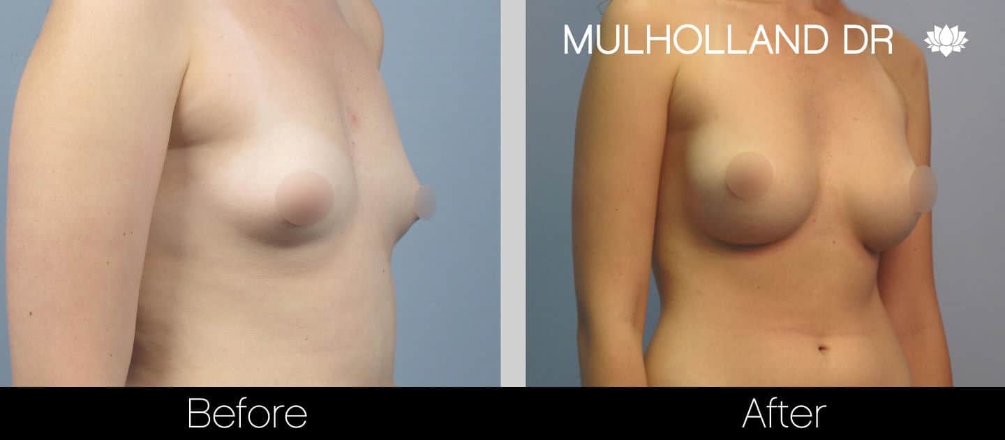 Breast Augmentation - Before and After Gallery - Patient Photo 24