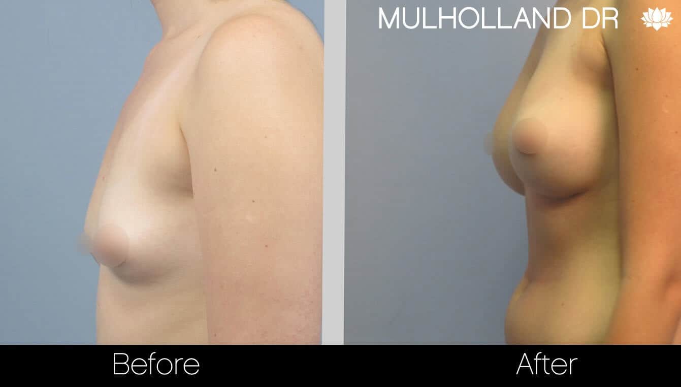 Breast Augmentation - Before and After Gallery - Patient Photo 25