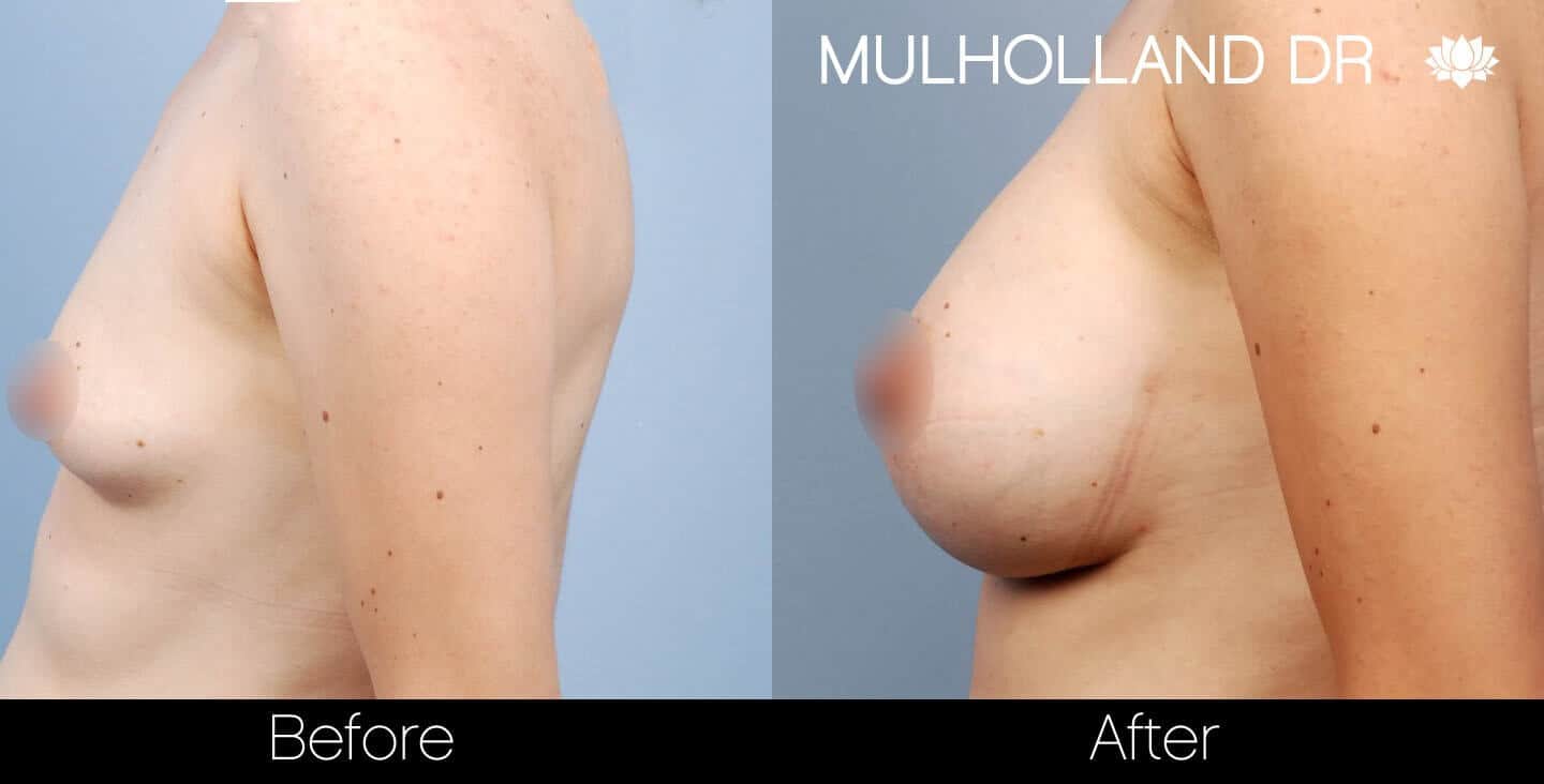 Breast Augmentation - Before and After Gallery - Patient Photo 27
