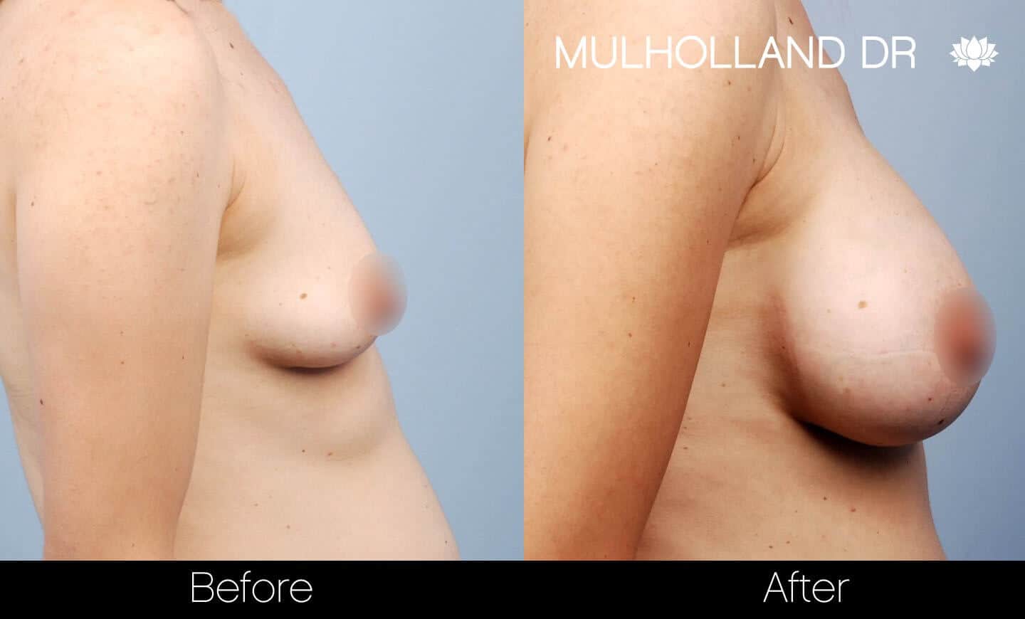 Breast Augmentation - Before and After Gallery - Patient Photo 28