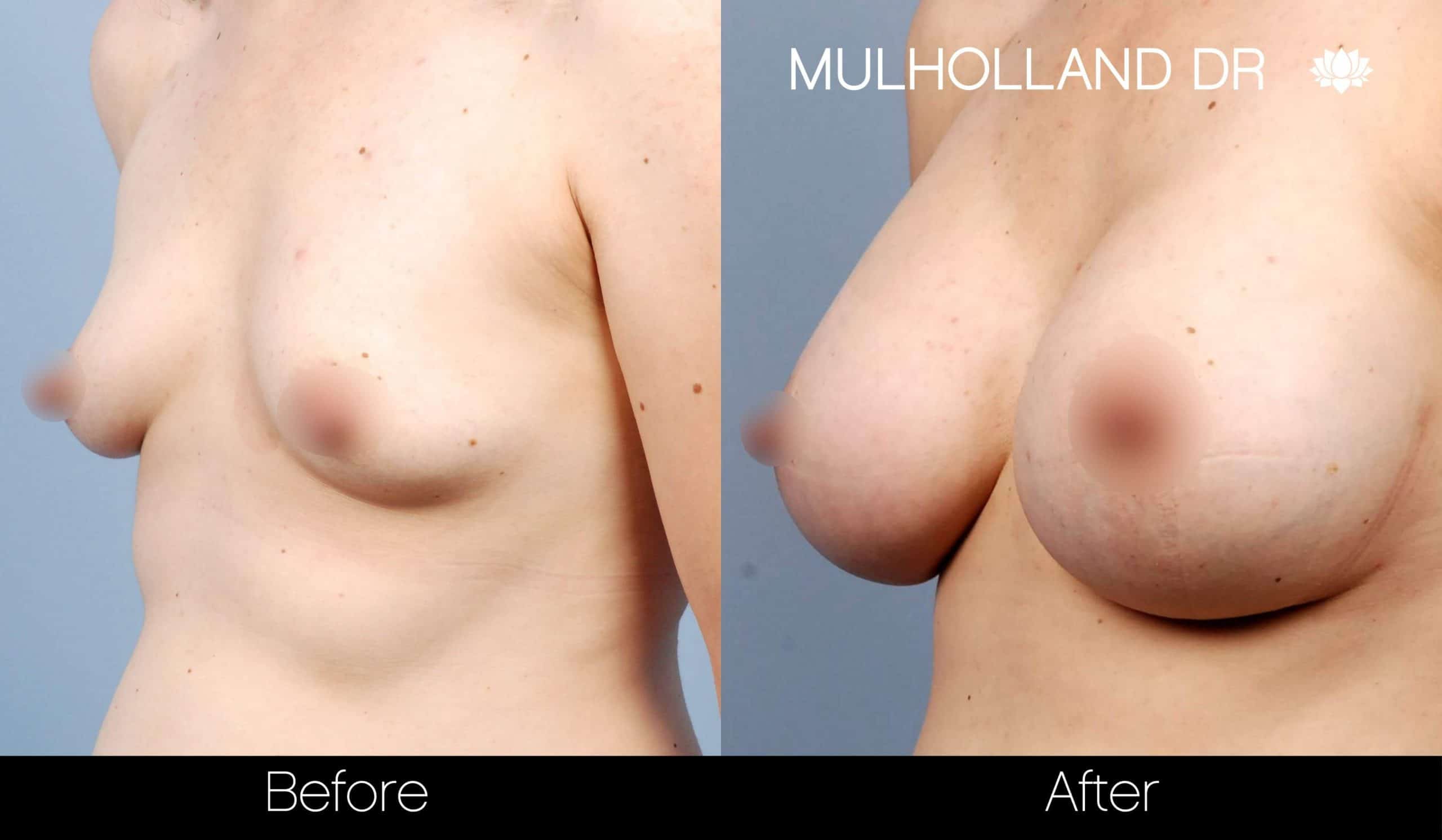 Breast Augmentation - Before and After Gallery - Patient Photo 29