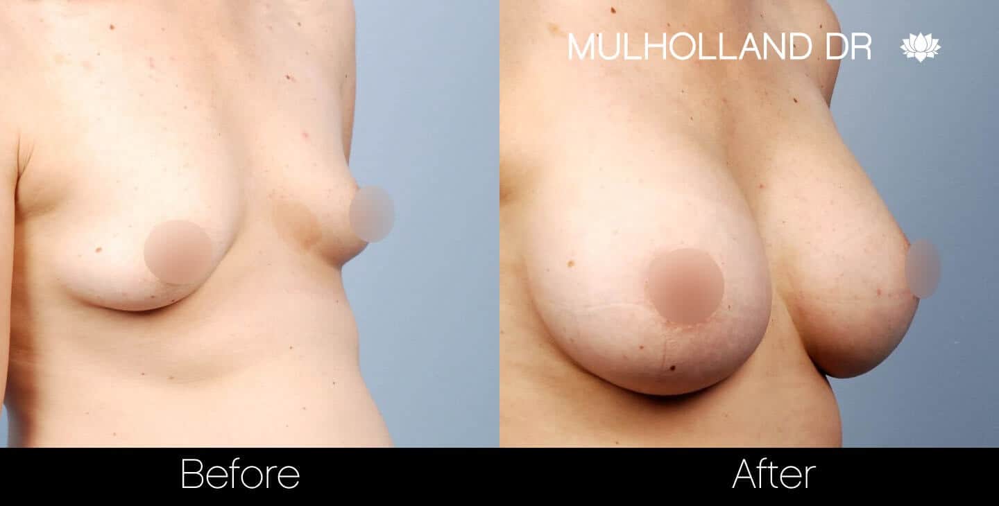 Breast Augmentation - Before and After Gallery - Patient Photo 30