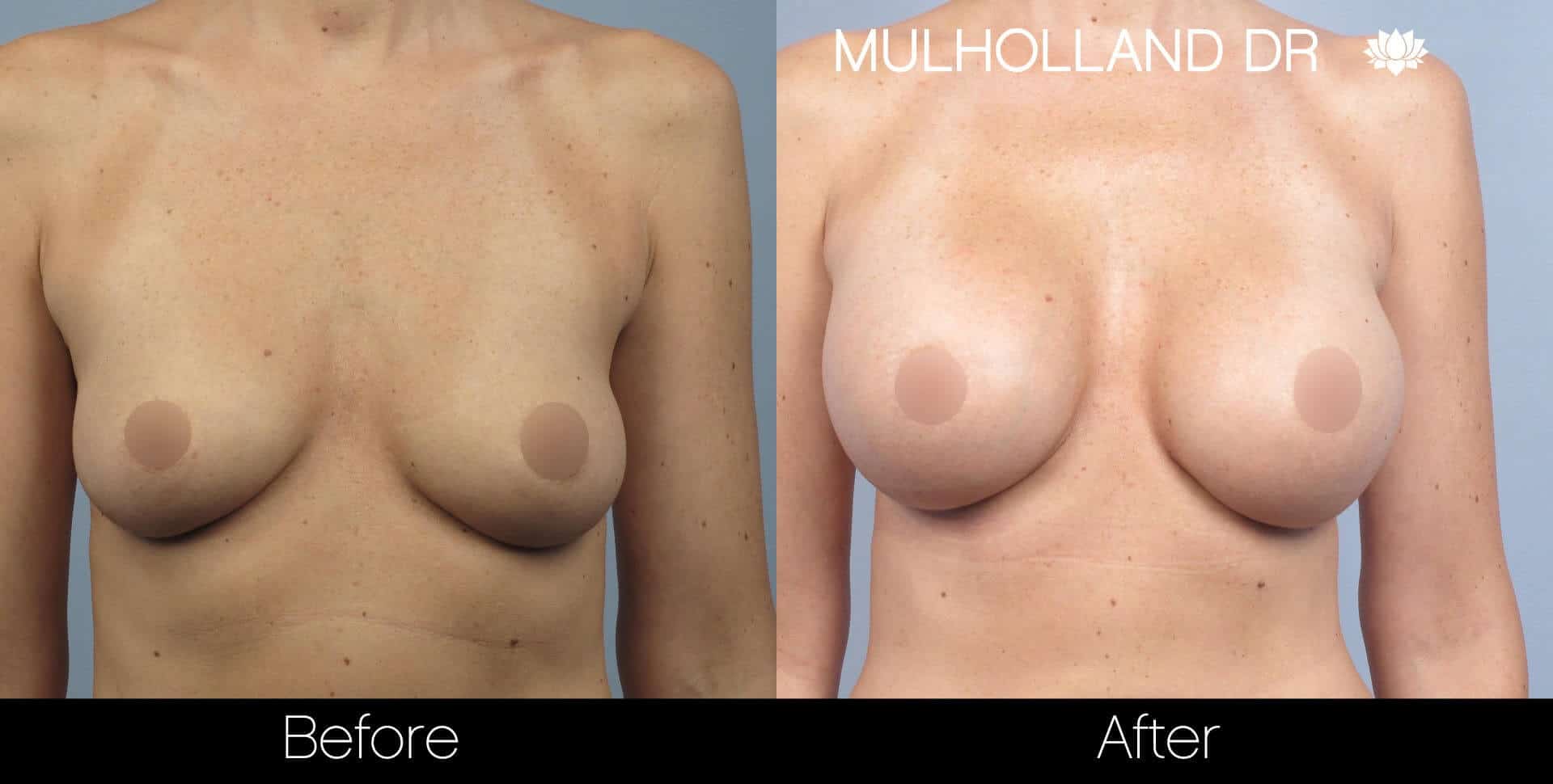 Breast Augmentation - Before and After Gallery - Patient Photo 31