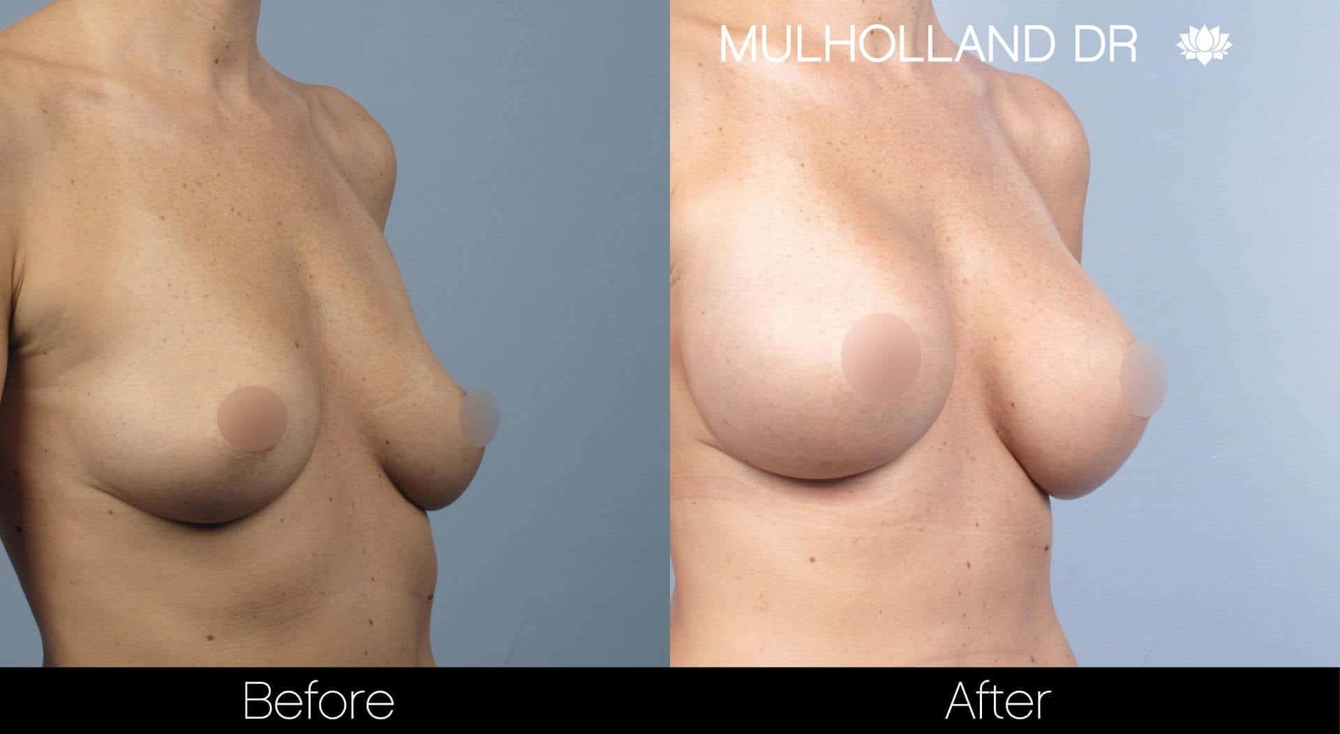 Breast Augmentation - Before and After Gallery - Patient Photo 32