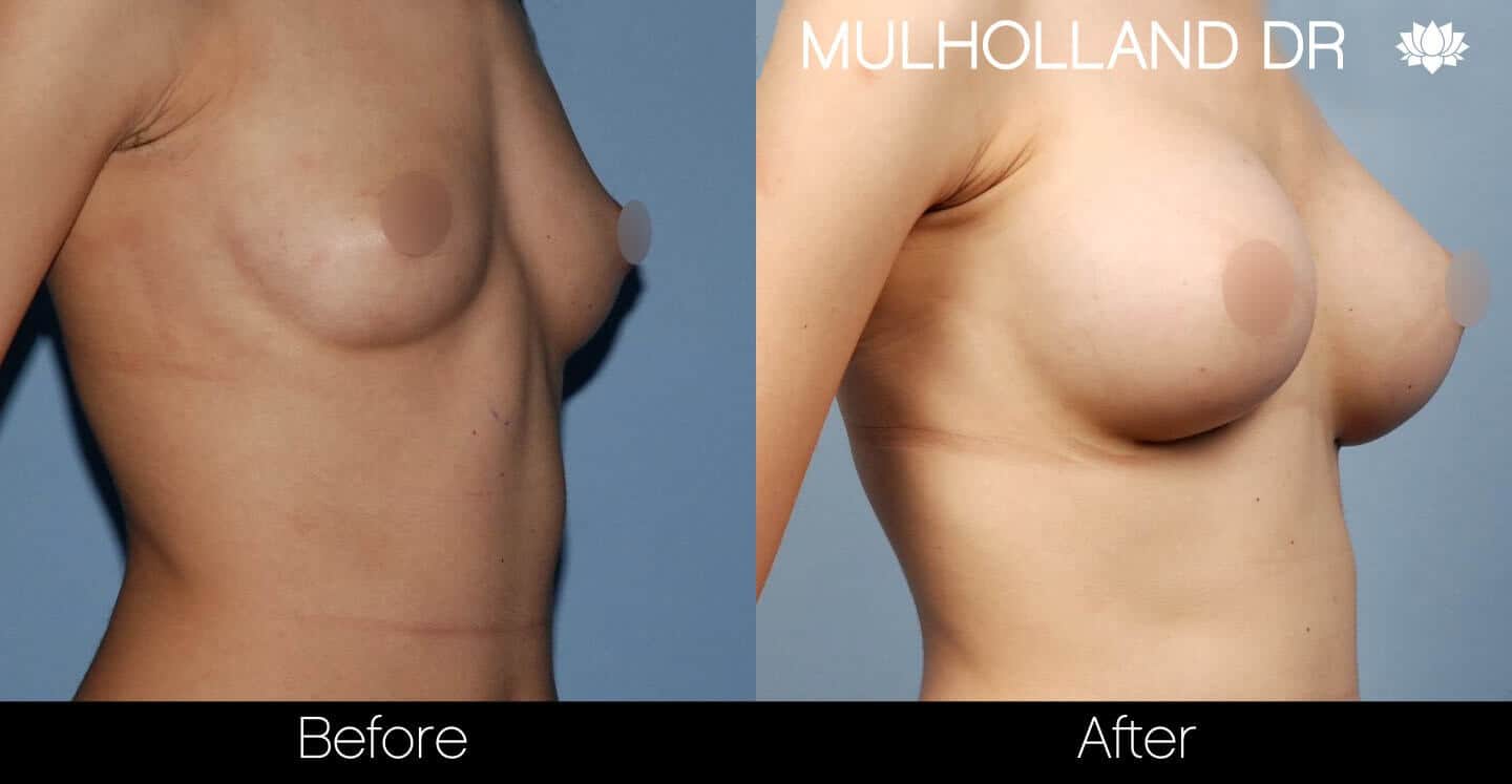 Breast Augmentation - Before and After Gallery - Patient Photo 34