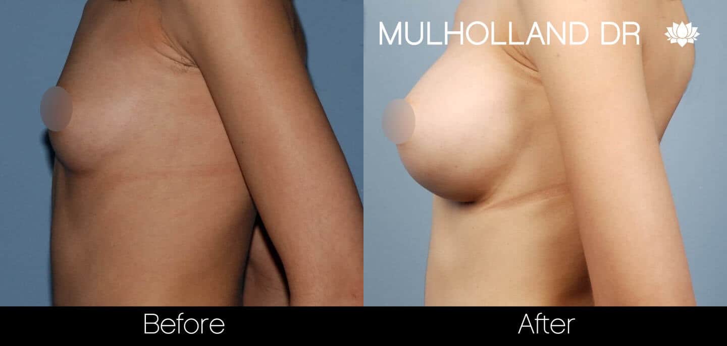 Breast Augmentation - Before and After Gallery - Patient Photo 35