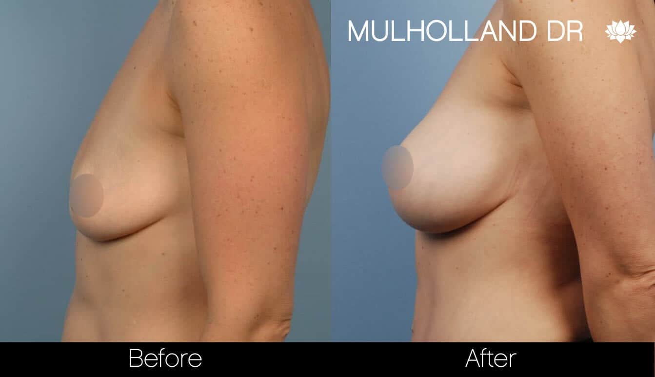 Breast Augmentation - Before and After Gallery - Patient Photo 37