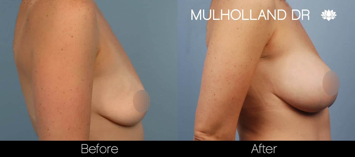 Breast Augmentation - Before and After Gallery - Patient Photo 38