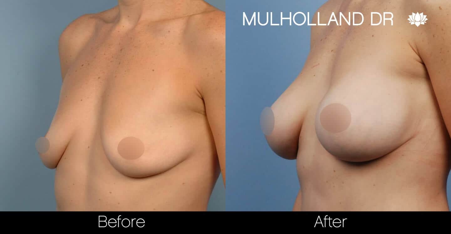 Breast Augmentation - Before and After Gallery - Patient Photo 39