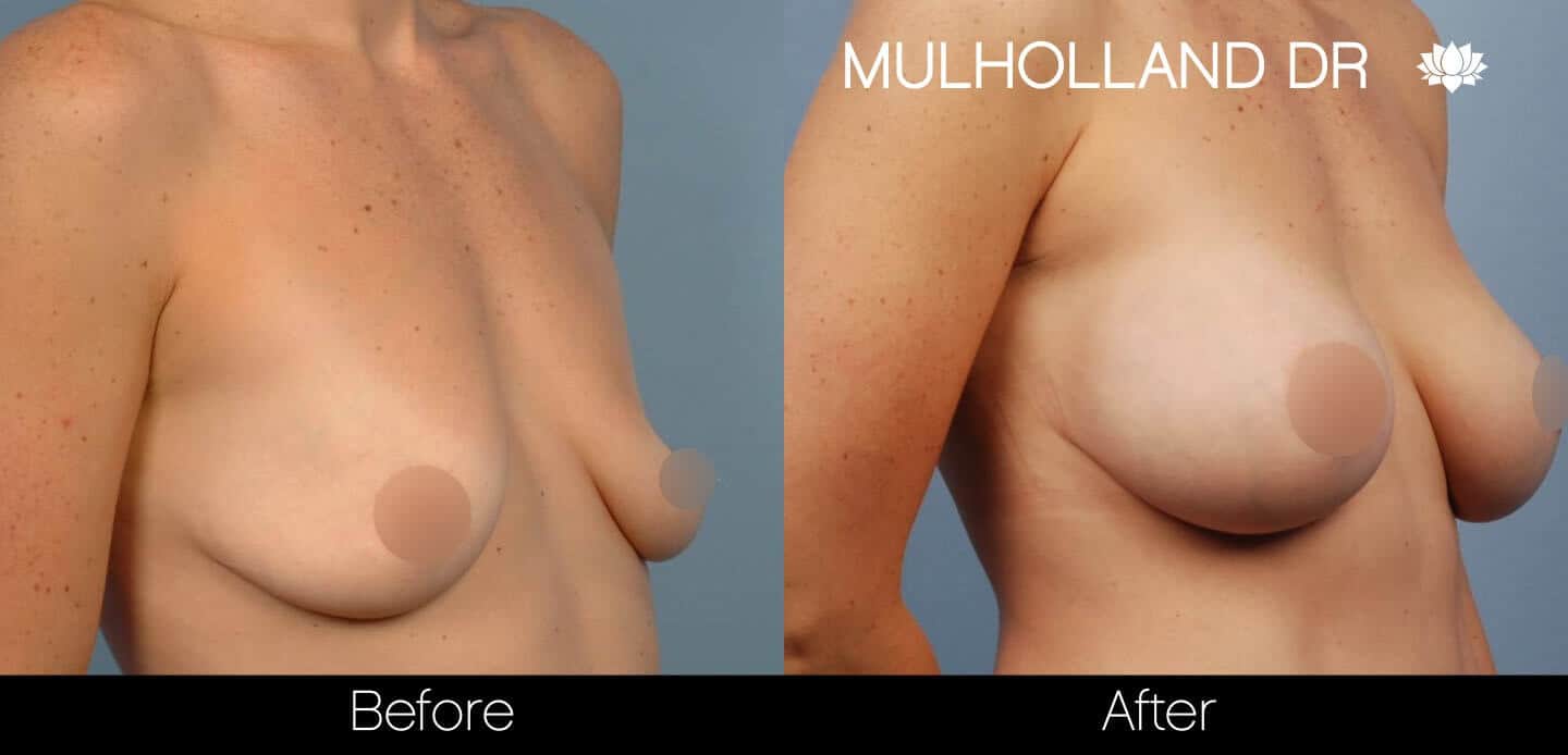 Breast Augmentation - Before and After Gallery - Patient Photo 40