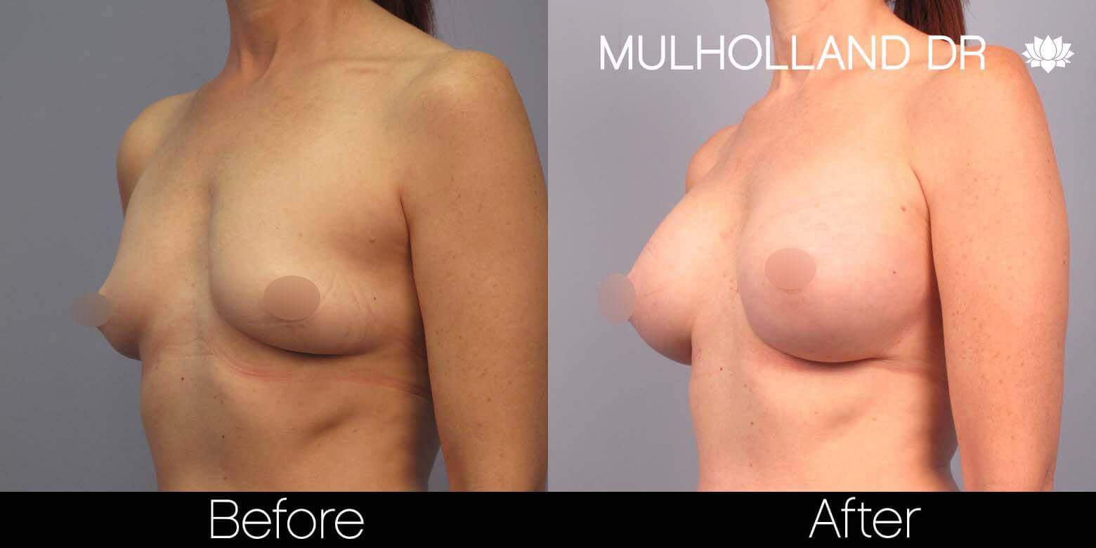 Breast Augmentation - Before and After Gallery - Patient Photo 41