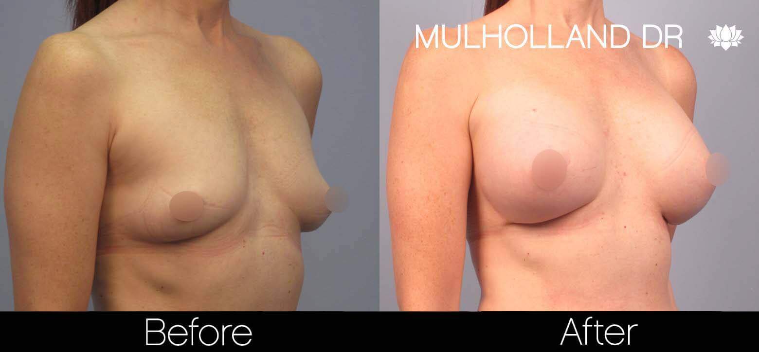 Breast Augmentation - Before and After Gallery - Patient Photo 42