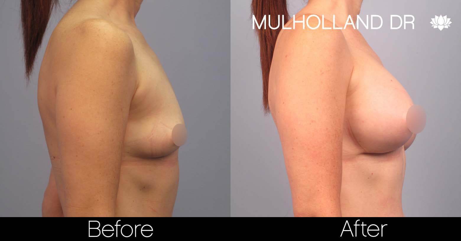 Breast Augmentation - Before and After Gallery - Patient Photo 43