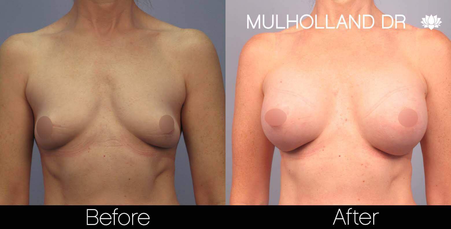 Breast Augmentation - Before and After Gallery - Patient Photo 44