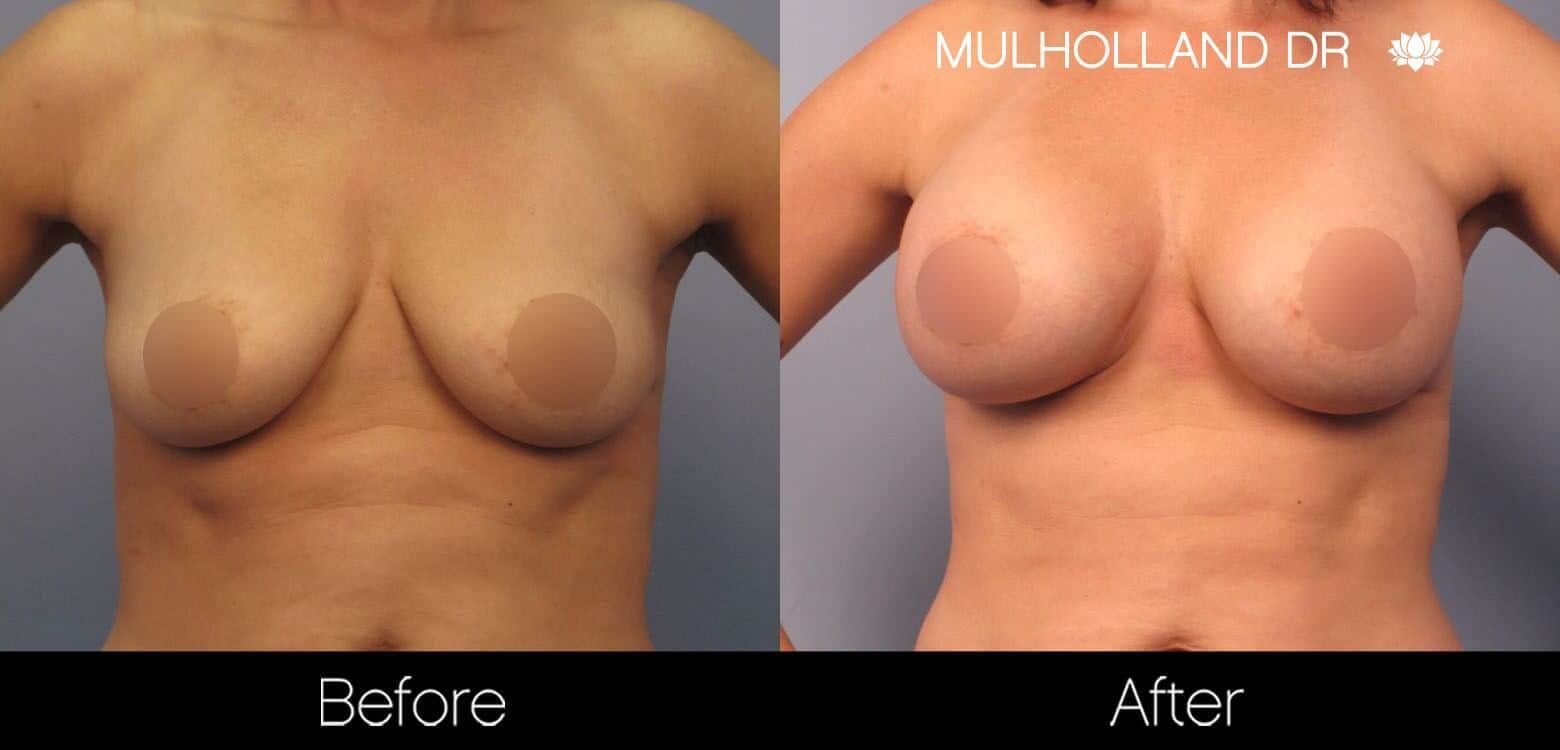 Breast Augmentation - Before and After Gallery - Patient Photo 45