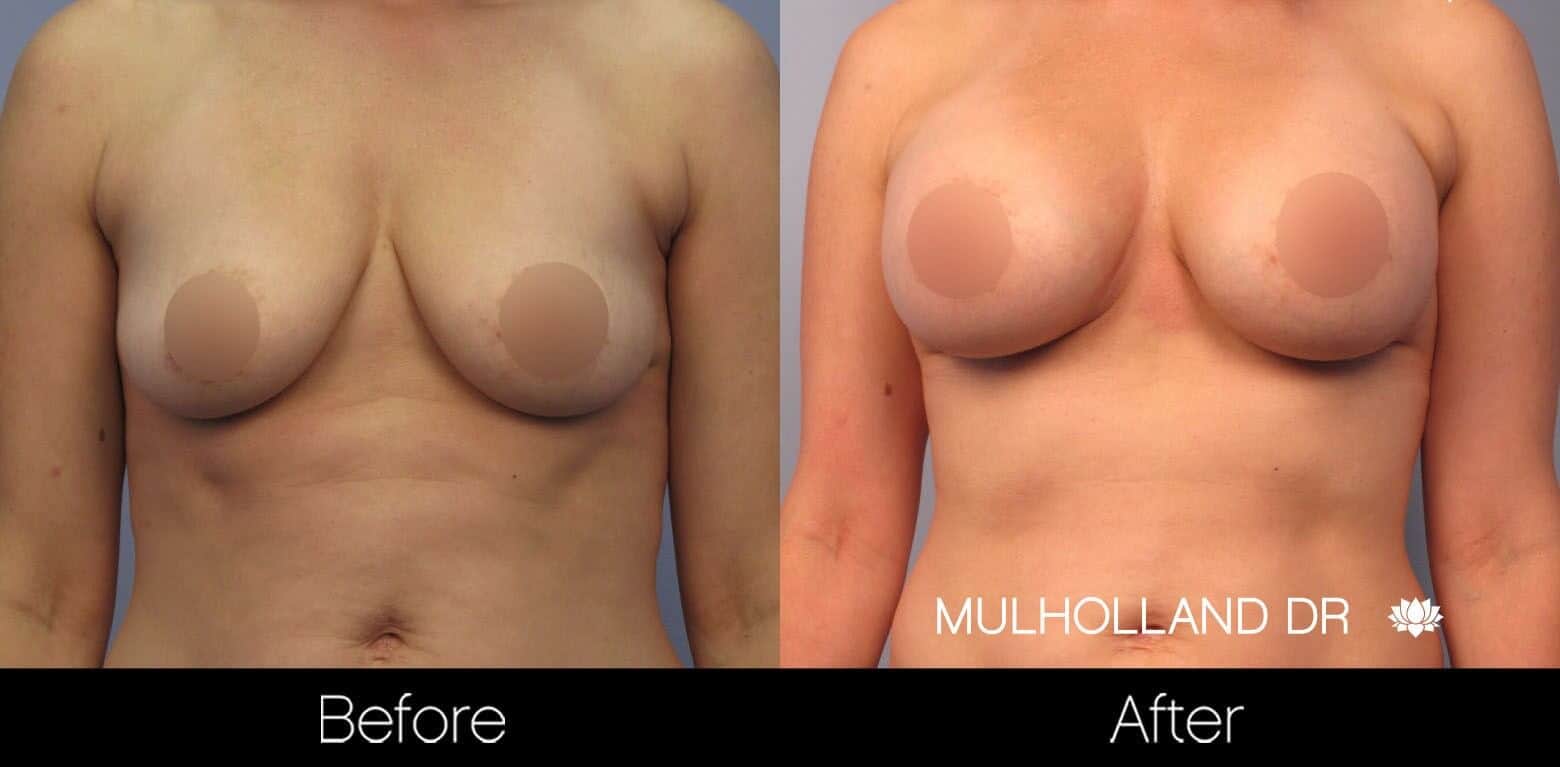 Breast Augmentation - Before and After Gallery - Patient Photo 46