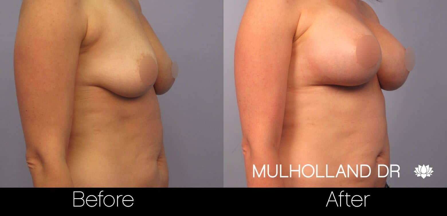 Breast Augmentation - Before and After Gallery - Patient Photo 48