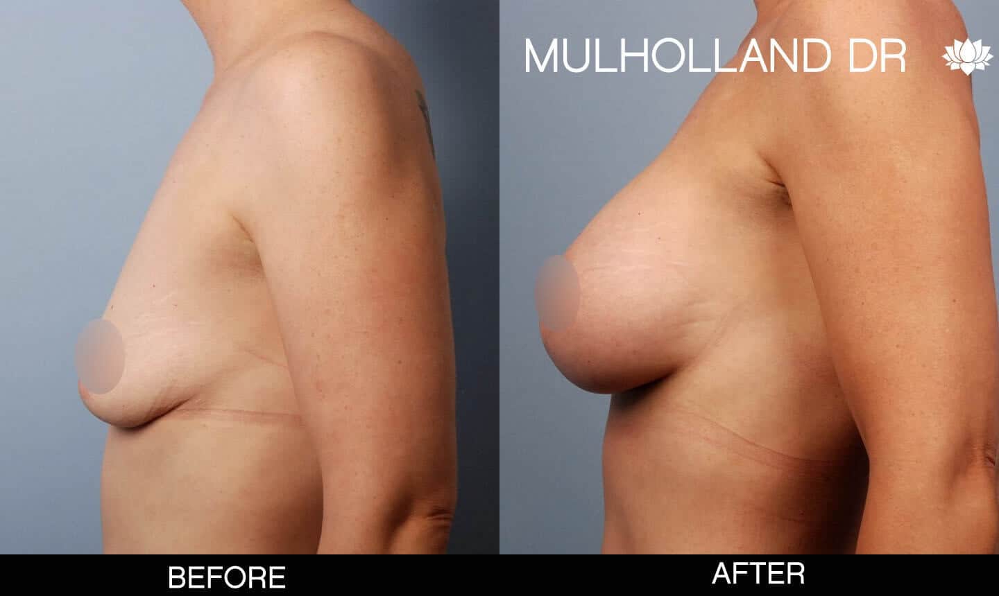 Breast Augmentation - Before and After Gallery - Patient Photo 49