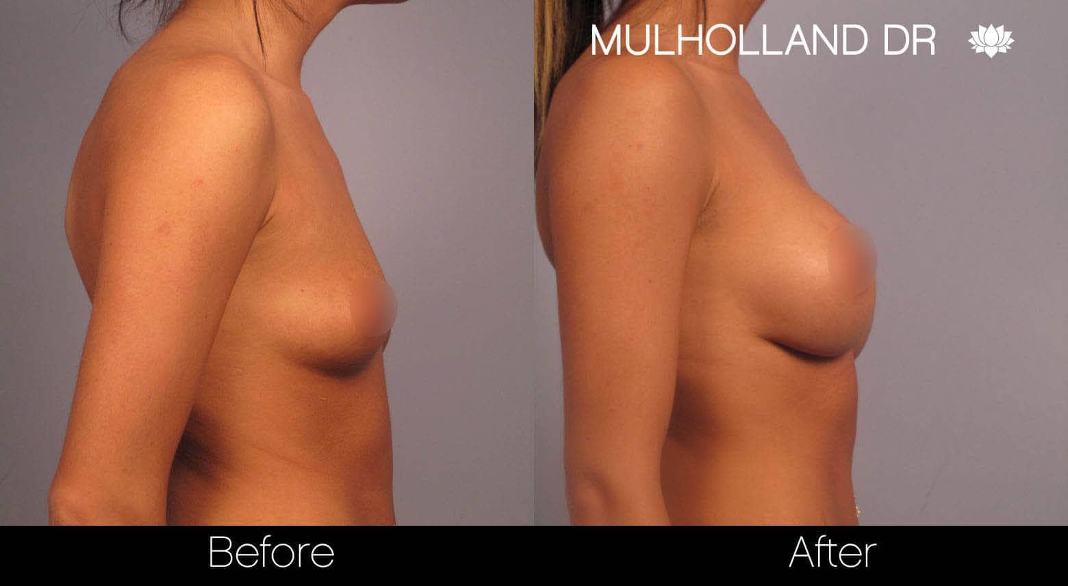 Breast Augmentation - Before and After Gallery - Patient Photo 5