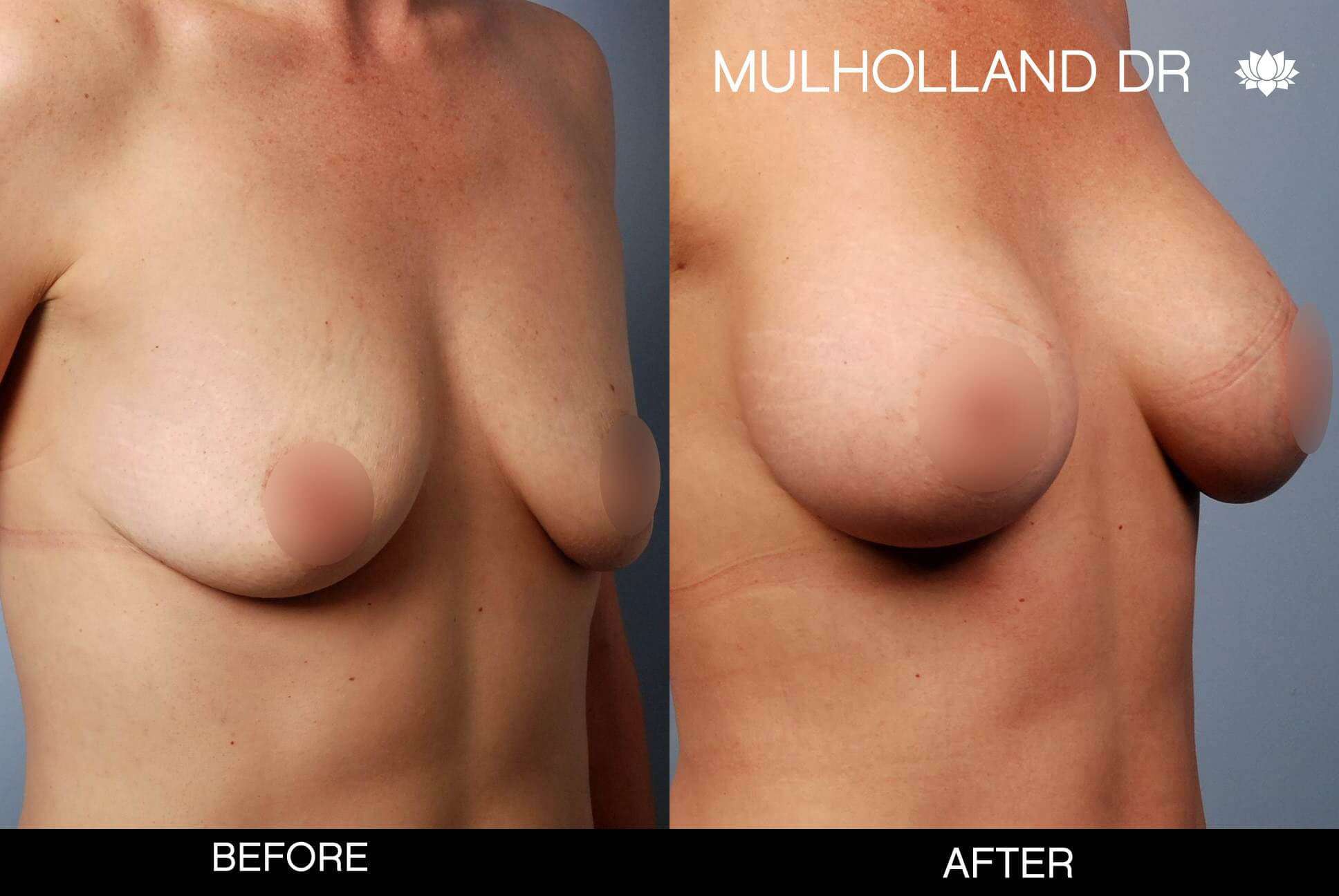 Breast Augmentation - Before and After Gallery - Patient Photo 50