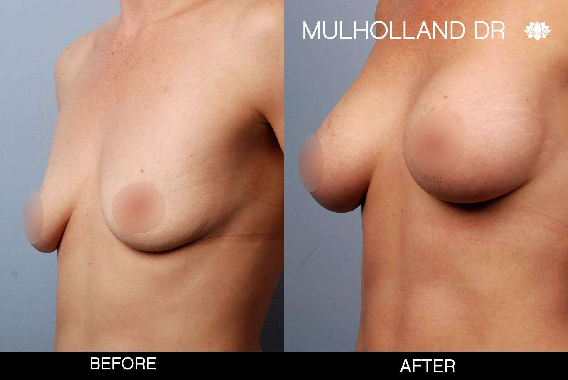 Breast Augmentation - Before and After Gallery - Patient Photo 51