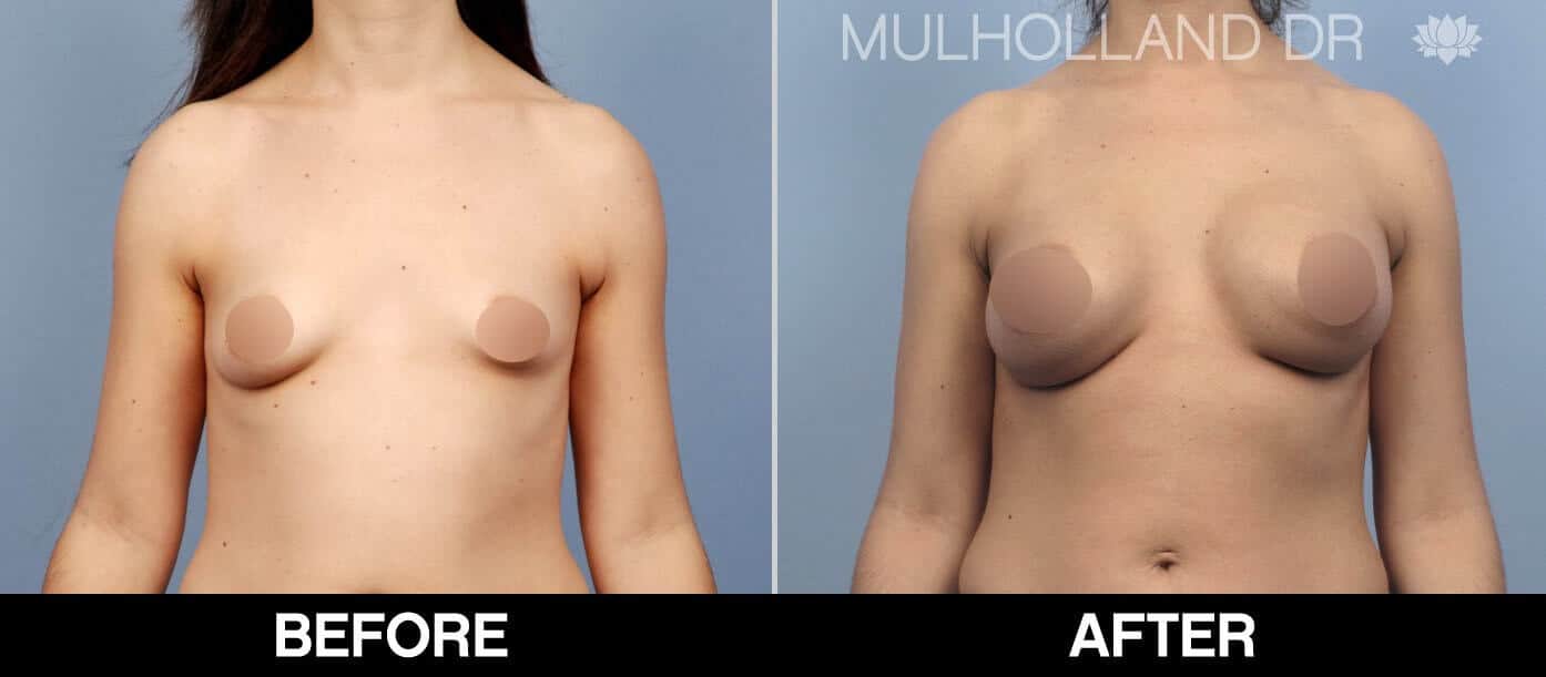 Breast Augmentation - Before and After Gallery - Patient Photo 53