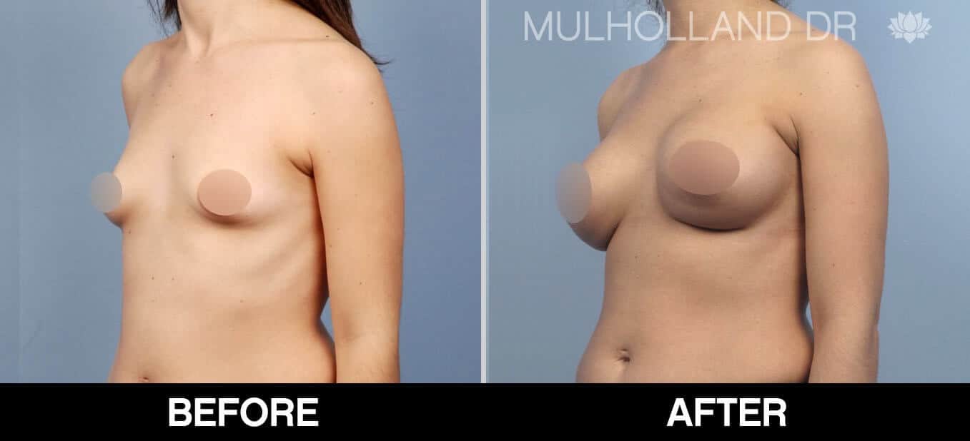 Breast Augmentation - Before and After Gallery - Patient Photo 54
