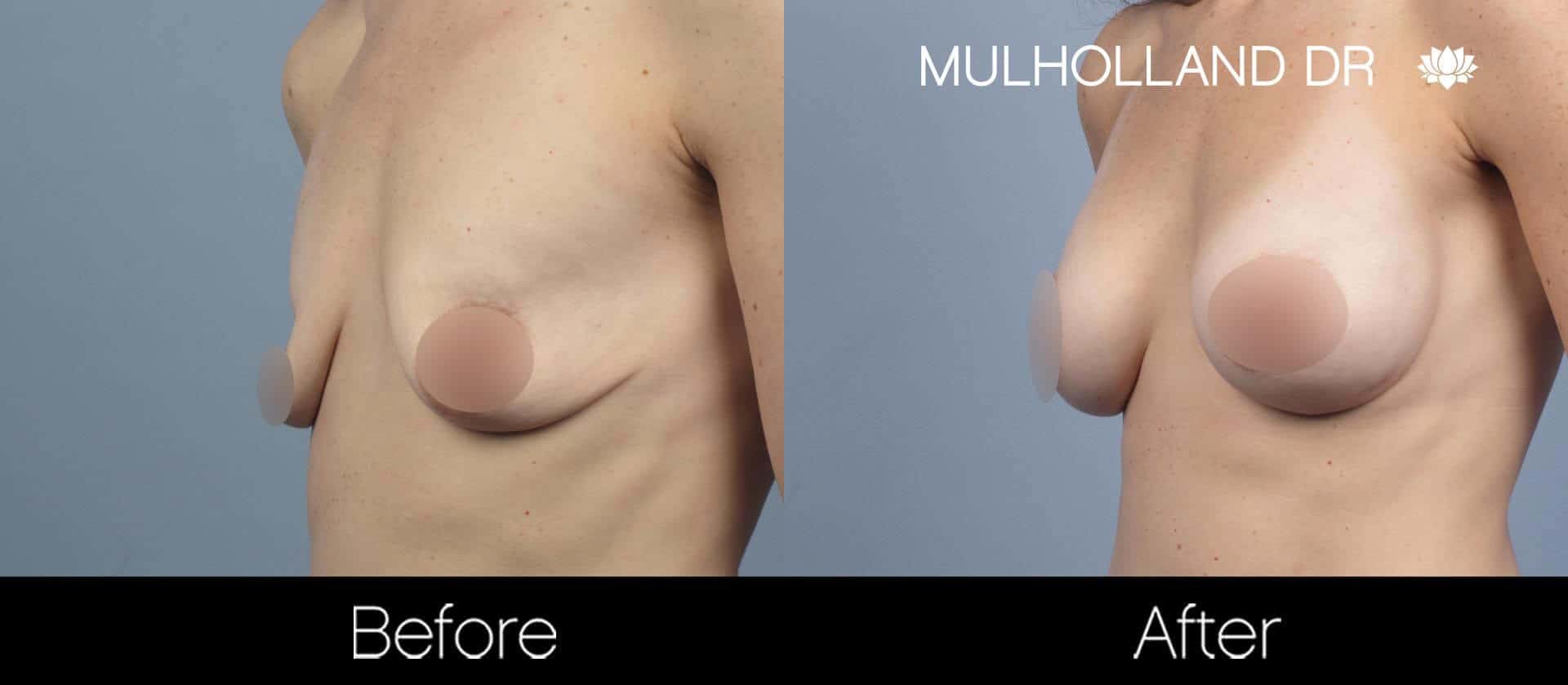 Breast Augmentation - Before and After Gallery - Patient Photo 55