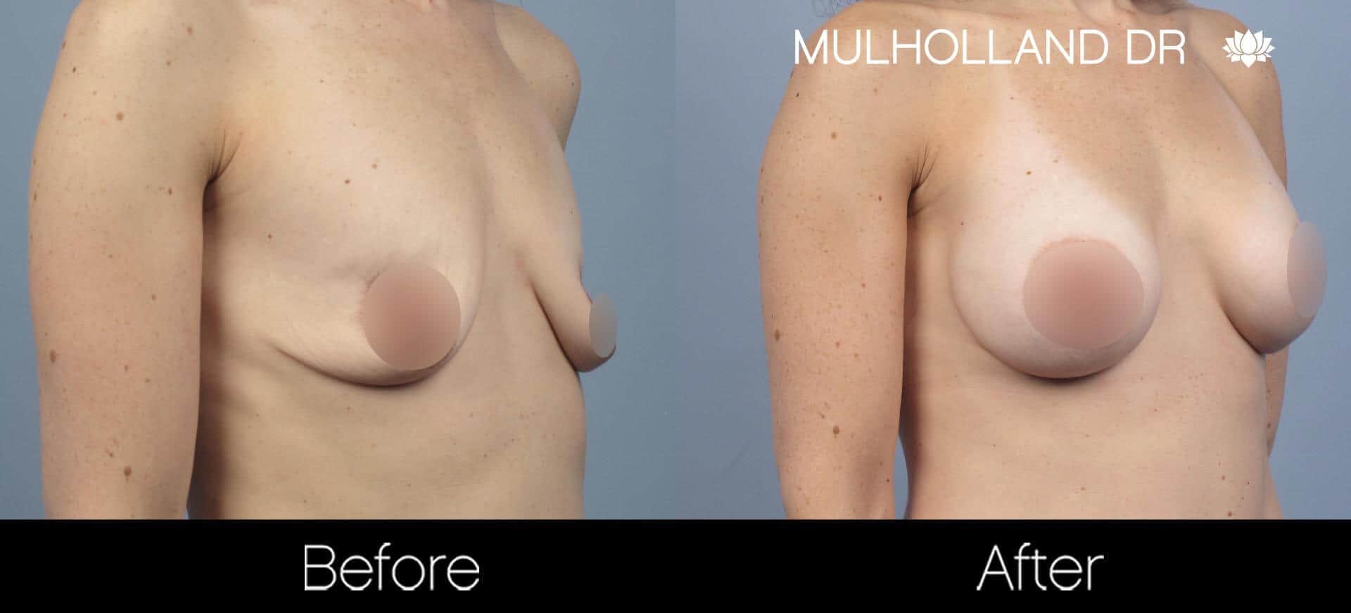 Breast Augmentation - Before and After Gallery - Patient Photo 56