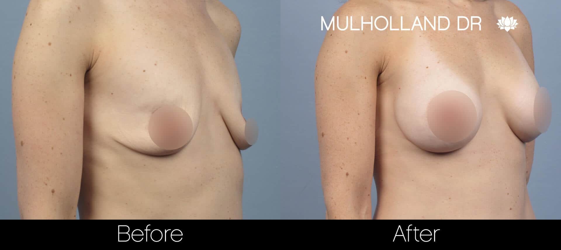 Breast Augmentation - Before and After Gallery - Patient Photo 58