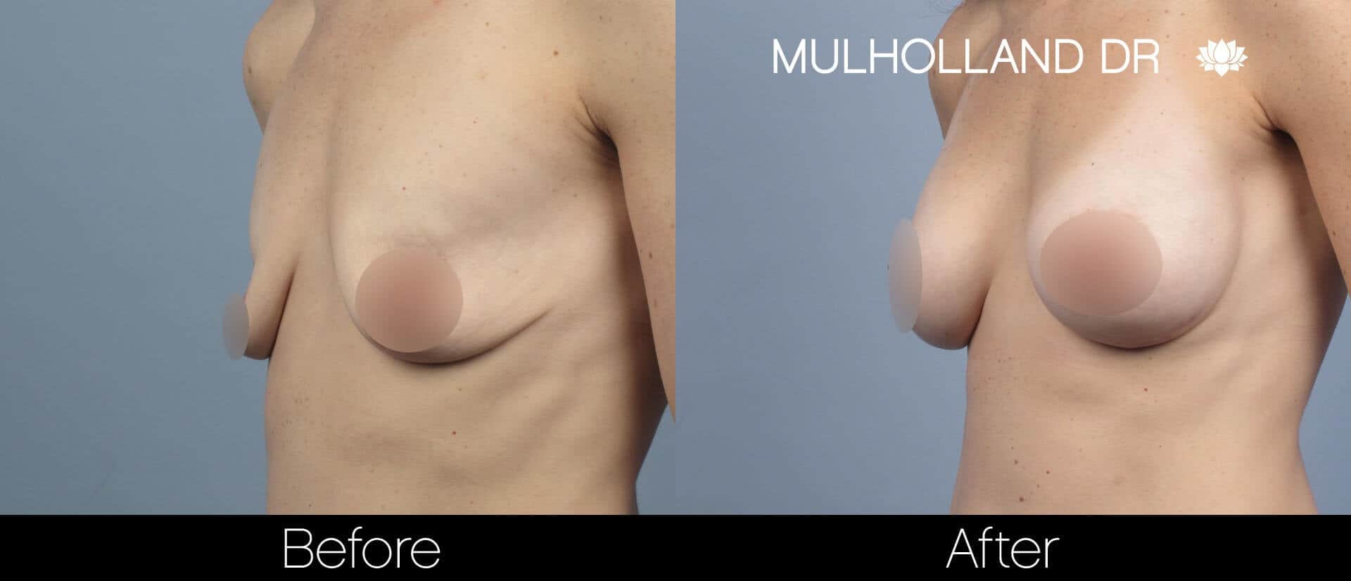 Breast Augmentation - Before and After Gallery - Patient Photo 59