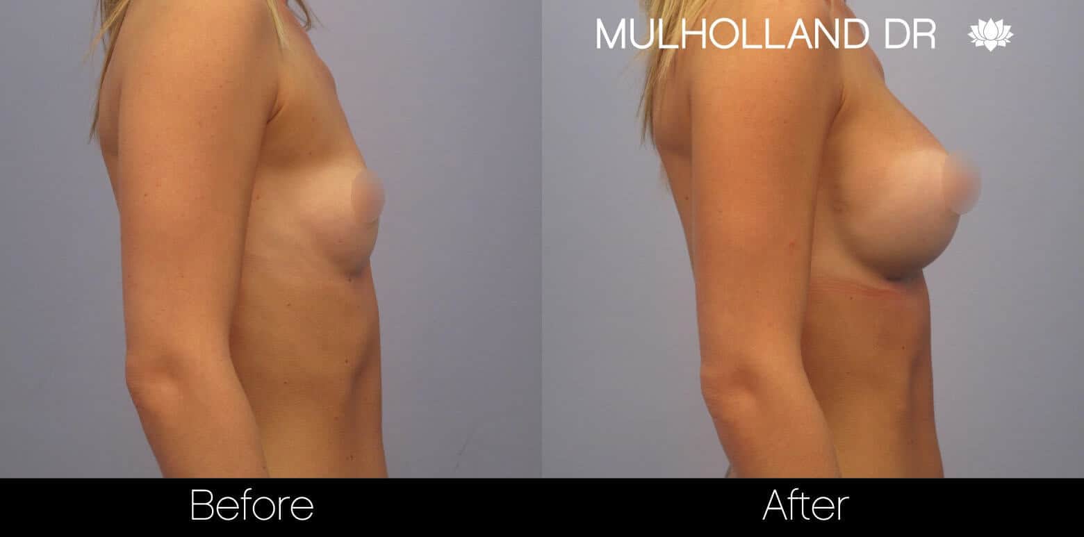 Breast Augmentation - Before and After Gallery - Patient Photo 6