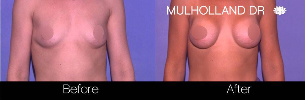 Breast Augmentation - Before and After Gallery - Patient Photo 61