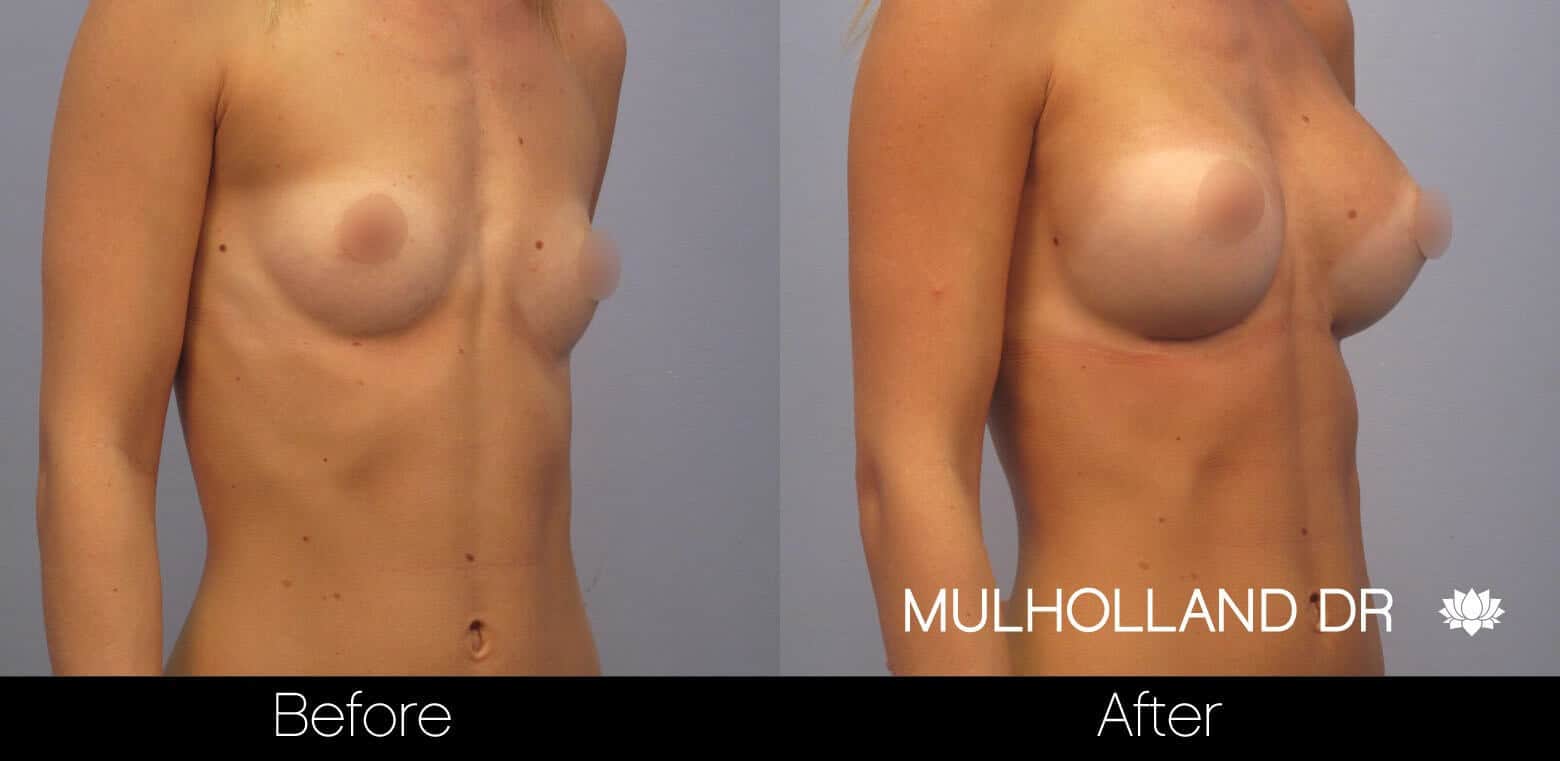Breast Augmentation - Before and After Gallery - Patient Photo 7