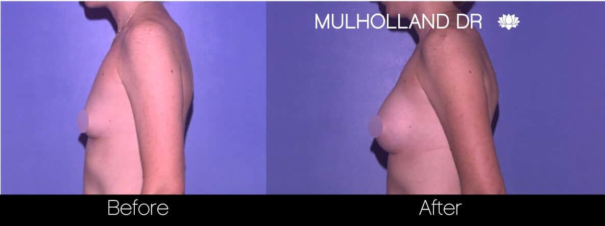 Breast Augmentation - Before and After Gallery - Patient Photo 76