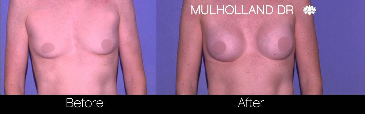 Breast Augmentation - Before and After Gallery - Patient Photo 78