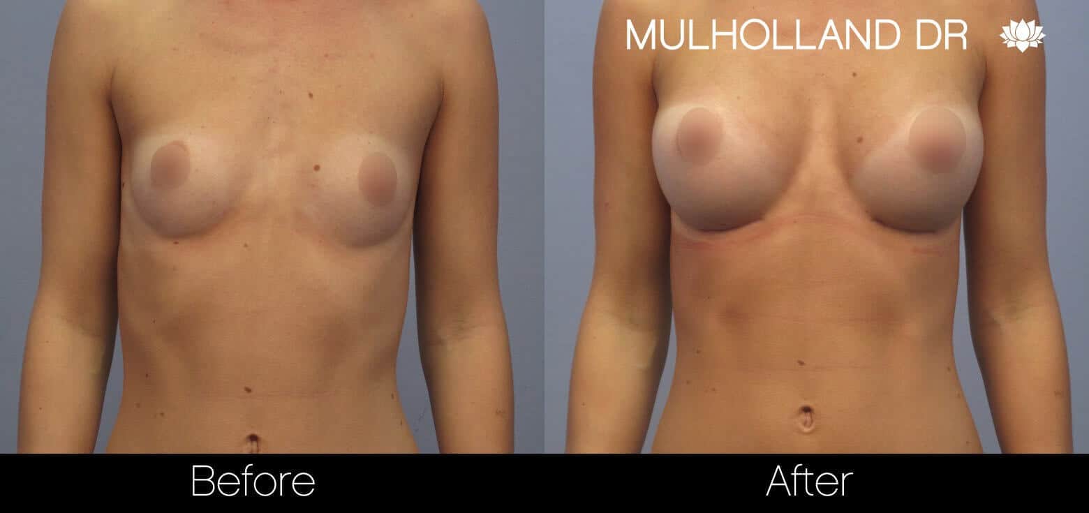 Breast Augmentation - Before and After Gallery - Patient Photo 8