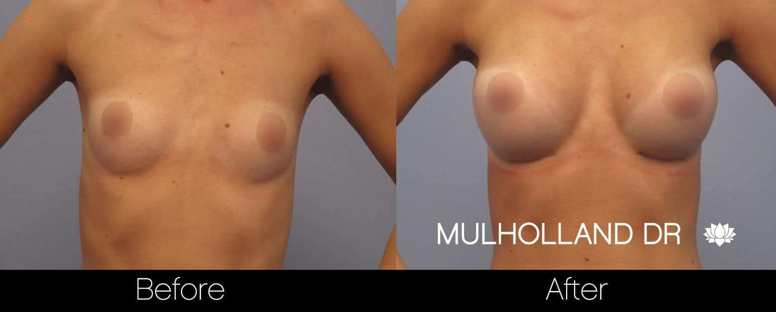 Breast Augmentation - Before and After Gallery - Patient Photo 9