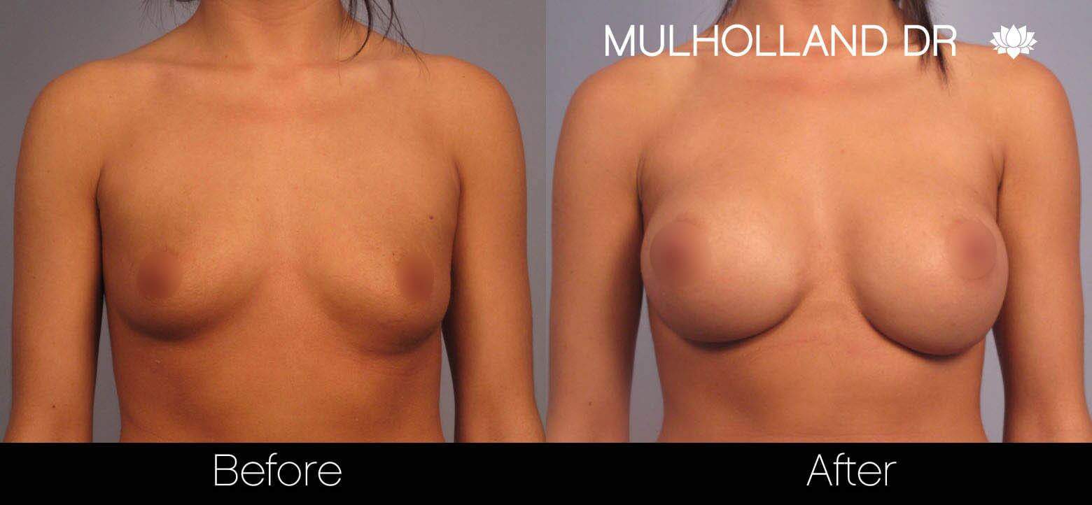 Breast Augmentation - Before and After Gallery - Patient Photo