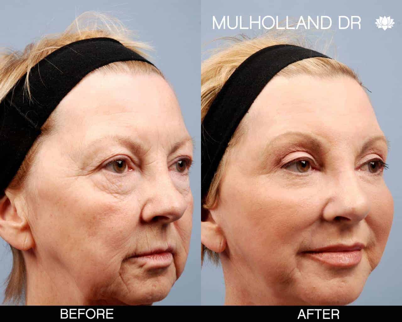 Brow Lift - Before and After Gallery - Patient Photo 11