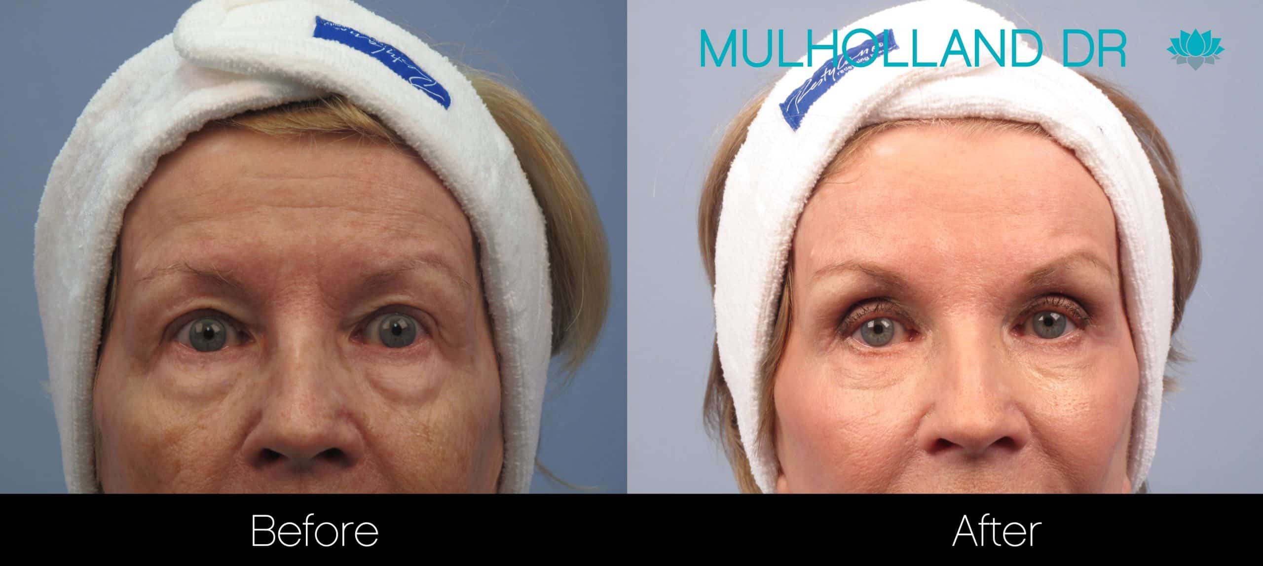 Brow Lift - Before and After Gallery - Patient Photo 29