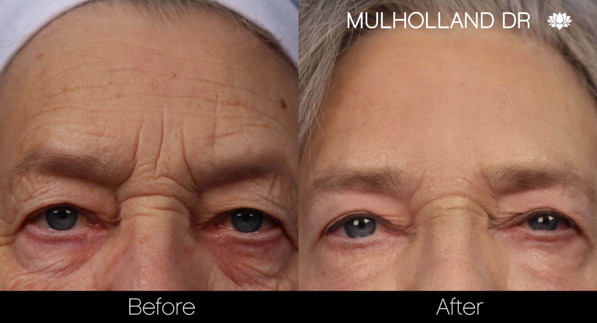 Brow Lift - Before and After Gallery - Patient Photo 31