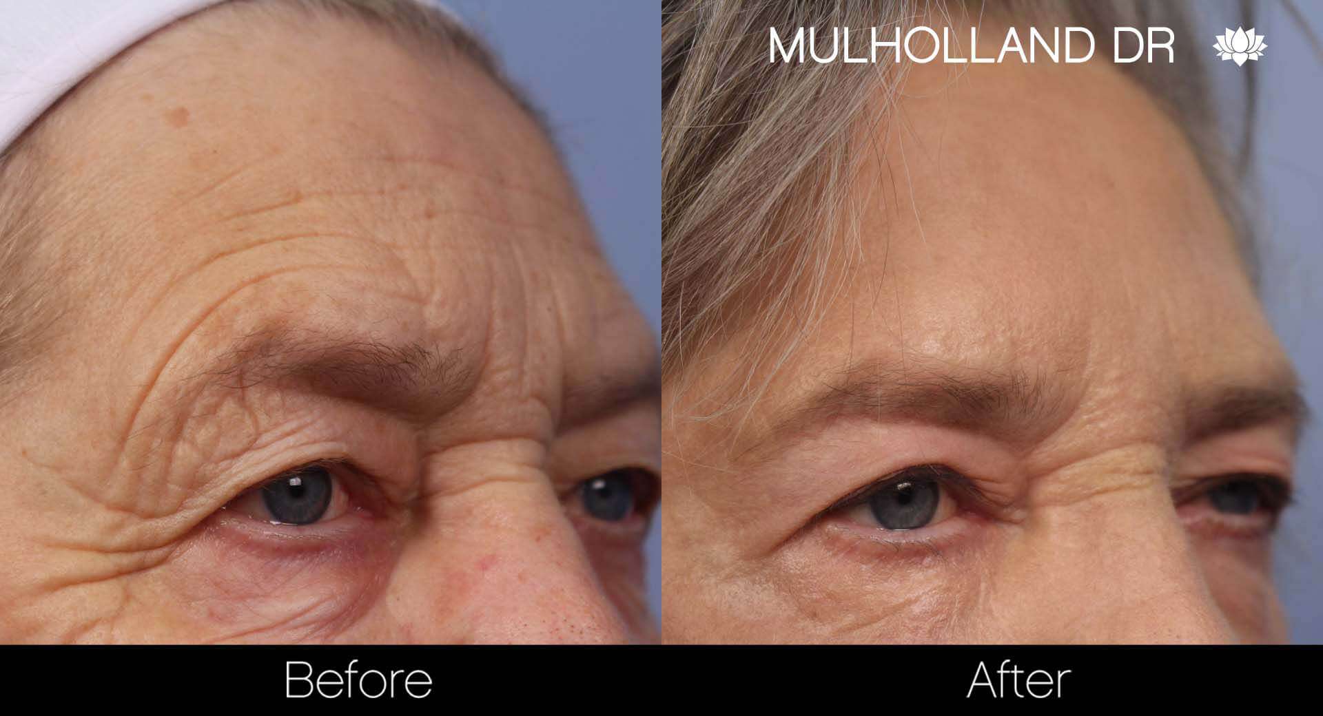 Brow Lift - Before and After Gallery - Patient Photo 32