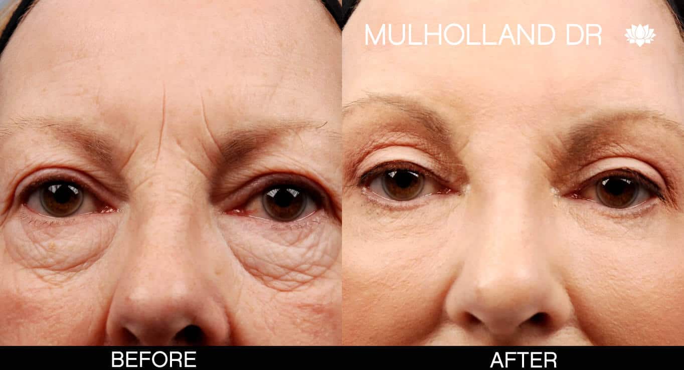 Brow Lift - Before and After Gallery - Patient Photo 9