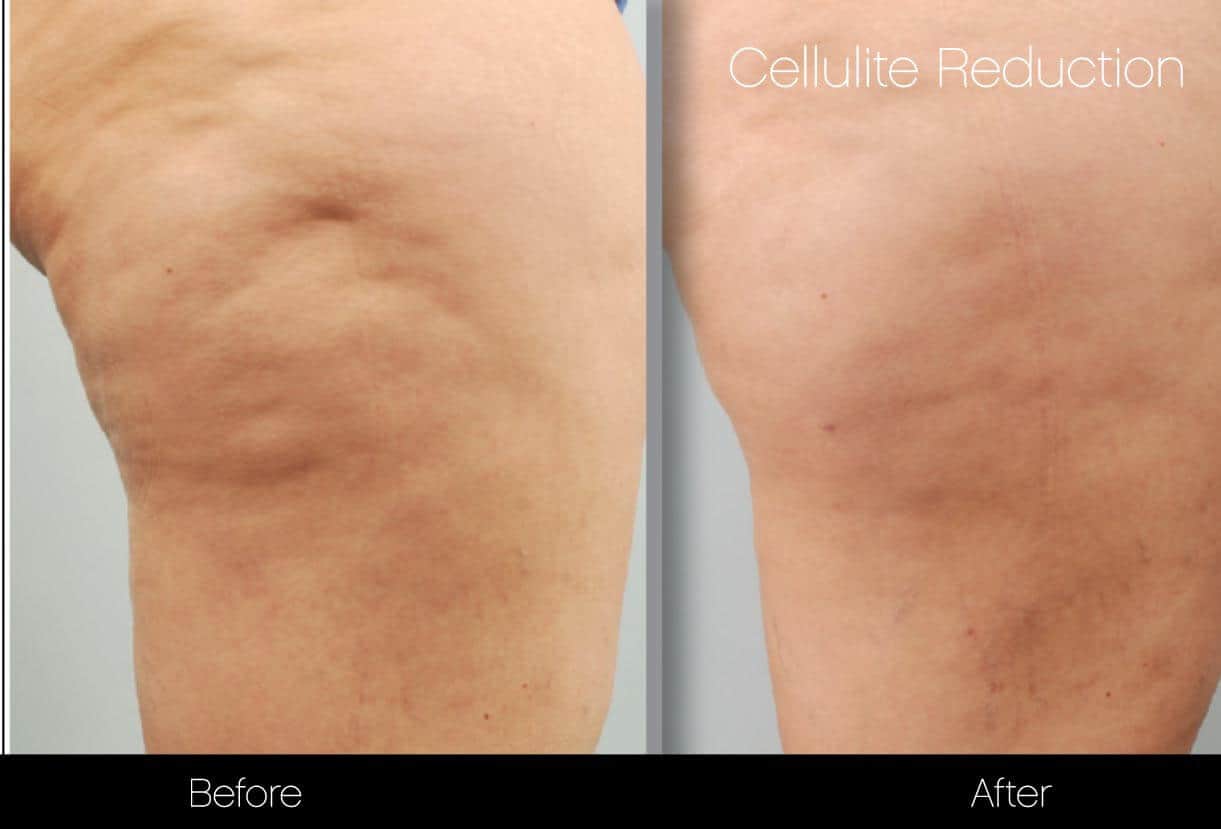 Cellutite -Before and After Gallery - Patient Photo 12